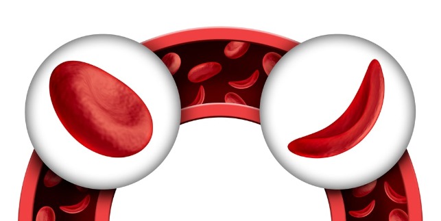 to describe differences of sickle cell anemia for burial insurance